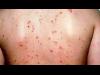 ثورة علاجية في الأمراض الجلدية بالمواد الحيوية