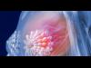 اختبارات جينية جديدة لأورام سرطان الثدى