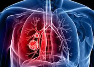طفرة في علاج سرطان الرئة تركز على تنشيط الجهاز المناعي