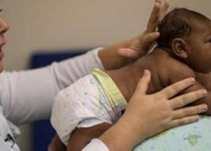 مولد أول رضيع مصاب بصغر حجم الرأس بسبب فيروس زيكا في نيويورك