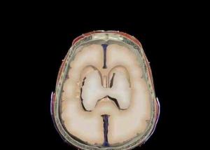 دراسة: تأخر مريض ارتجاج المخ في تناول العلاج يطيل فترة النقاهة