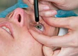 دراسة : الجراحات التجميلية للعين قد تخفف الصداع النصفى